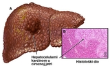 Hepatocelularni karcinom