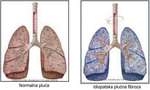 idiopatska plućna fibroza