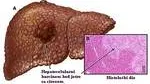 Hepatocelularni Karcinom R