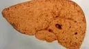Liver Fibrosis R