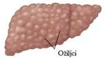 Oziljci-Na-Jetrima