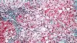 Steatohepatitis