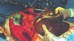 Transplantacija Jetre R
