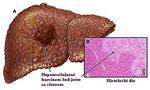 hepatocelularni karcinom